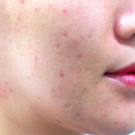 Sea Sail Beauty Clinic エリシスセンス 炎症性ニキビAfter