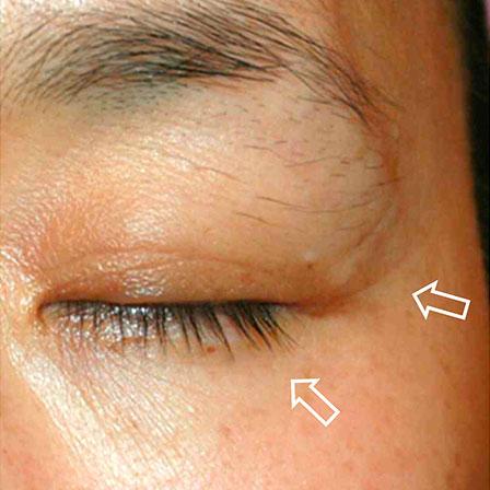 Sea Sail Beauty Clinic エリシスセンス 眼窩周囲シワAfter