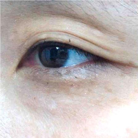 Sea Sail Beauty Clinic エリシスセンス 汗管腫After