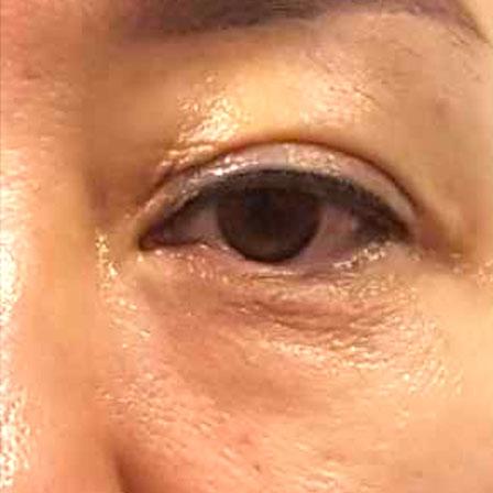 Sea Sail Beauty Clinic エリシスセンス 目の下の脂肪After