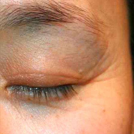 Sea Sail Beauty Clinic エリシスセンス 眼窩周囲シワBefore