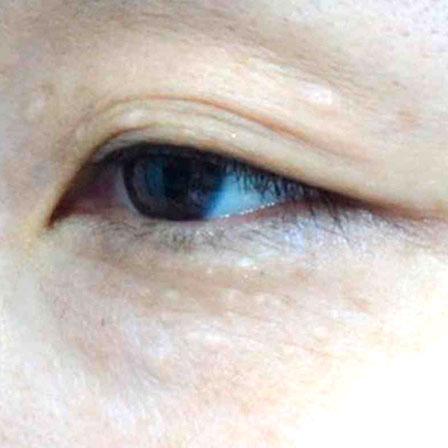 Sea Sail Beauty Clinic エリシスセンス 汗管腫Before