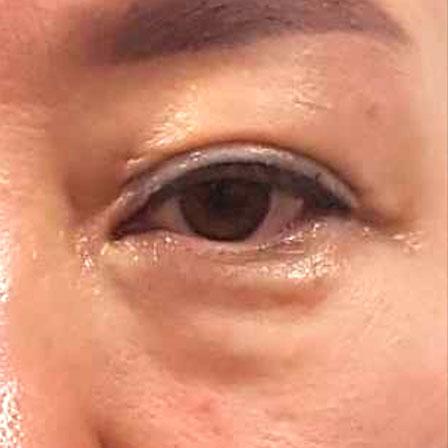 Sea Sail Beauty Clinic エリシスセンス 目の下の脂肪Before