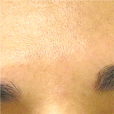 Sea Sail Beauty Clinic ハイドラフェイシャル シミAfter