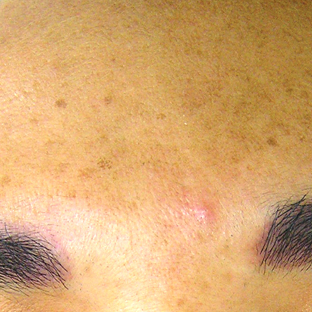 Sea Sail Beauty Clinic ハイドラフェイシャル シミBefore