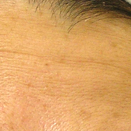 Sea Sail Beauty Clinic ハイドラフェイシャル 小じわBefore