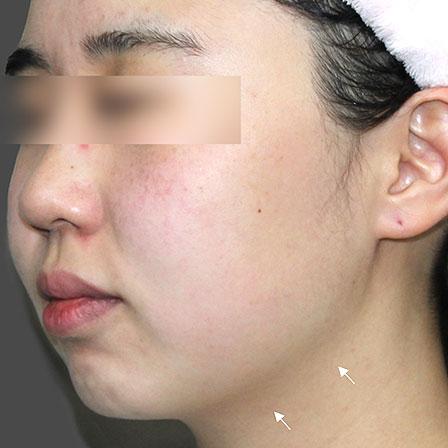 Sea Sail Beauty Clinic オリジオ X フェイスラインの改善After