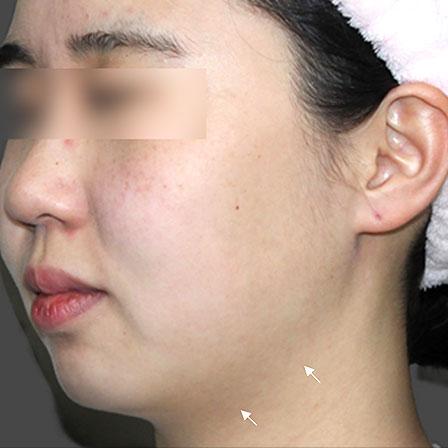 Sea Sail Beauty Clinic オリジオ X フェイスラインの改善Before