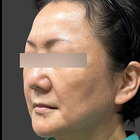 Sea Sail Beauty Clinic オリジオ X ほうれい線･フェイスラインの改善Before